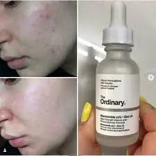 The Ordinary Niacinamide 10% + Zinc 1% – 30ml Techni Product